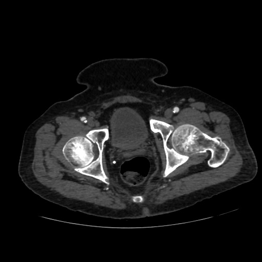 File:Abdominal aortic aneurysm (Radiopaedia 57318-64259 Axial C+ arterial phase 73).jpg