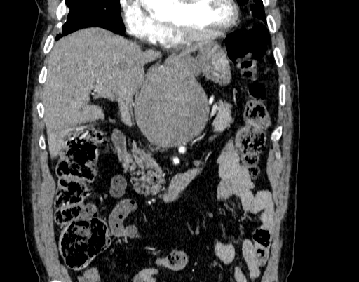 Abdominal aortic aneurysm (Radiopaedia 67117-76452 Coronal C+ arterial phase 32).jpg