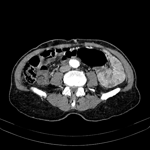 Abdominal aortic aneurysm (Radiopaedia 83581-98689 Axial C+ arterial phase 72).jpg