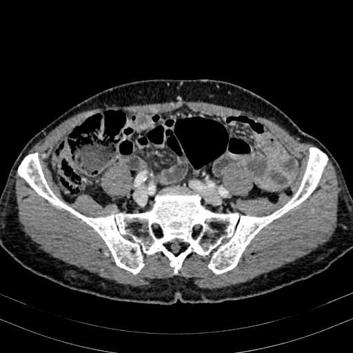 File:Abdominal aortic aneurysm (Radiopaedia 83581-98689 Axial C+ portal venous phase 82).jpg