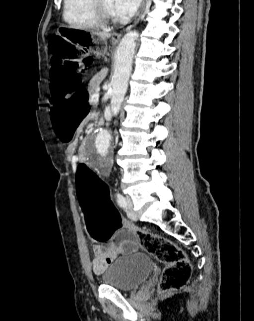 Abdominal aortic aneurysm (Radiopaedia 83581-98689 Sagittal C+ portal venous phase 62).jpg