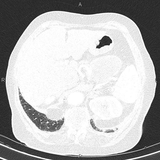 File:Abdominal aortic aneurysm (Radiopaedia 85063-100606 Axial lung window 61).jpg