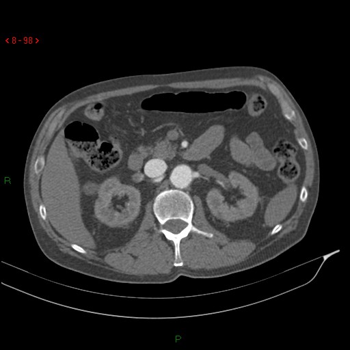 Abdominal aortic aneurysm rupture with aortocaval fistula (Radiopaedia 14897-14841 Axial C+ arterial phase 98).jpg