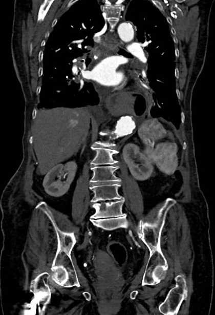 Abdominal aortic aneurysm with thrombus fissuration (Radiopaedia 73192-83919 Coronal C+ arterial phase 54).jpg