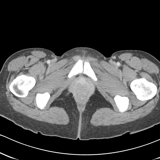 Abdominal desmoid tumor (Radiopaedia 41007-43740 Axial C+ portal venous phase 76).png