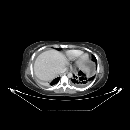 Abdominal gossypiboma- surgical towel (Radiopaedia 57288-64226 Axial C+ portal venous phase 3).jpg