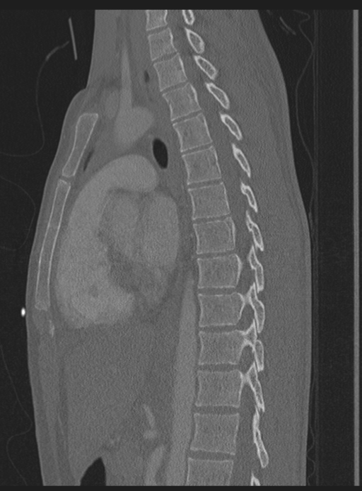 Abdominal multi-trauma - devascularised kidney and liver, spleen and pancreatic lacerations (Radiopaedia 34984-36486 Sagittal bone window 29).png