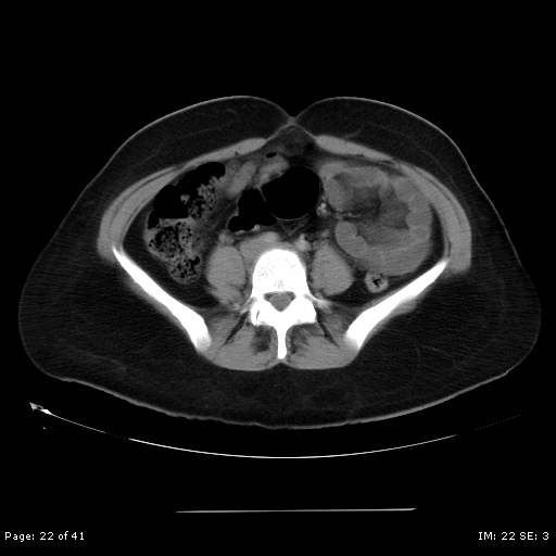 File:Abdominal wall endometriosis (Radiopaedia 25723-25885 Axial C+ portal venous phase 22).jpg