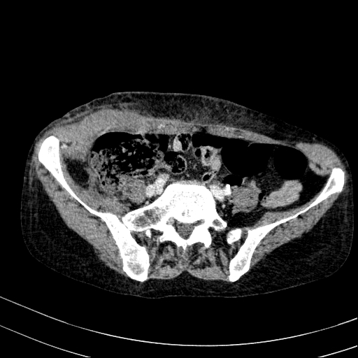 Abdominal wall hematoma with active bleeding (Radiopaedia 83915-99117 Axial C+ portal venous phase 89).jpg