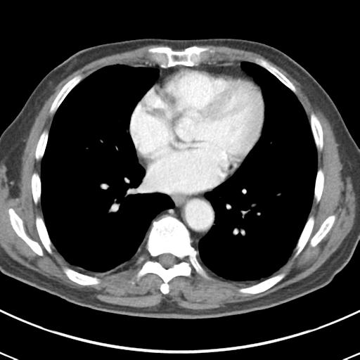 Abdominal wall metastasis from colorectal carcinoma (Radiopaedia 31016-31717 Axial C+ portal venous phase 2).jpg