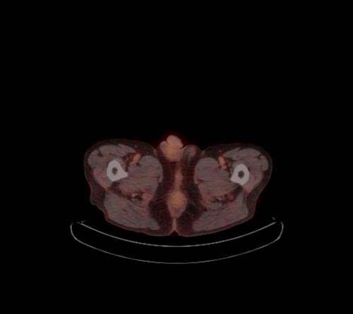Abdominal wall metastasis from colorectal carcinoma (Radiopaedia 31016-31719 C 10).jpg