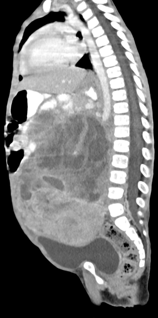 Abdominopelvic rhabdomyosarcoma (Radiopaedia 78356-90984 Sagittal C+ portal venous phase 43).jpg