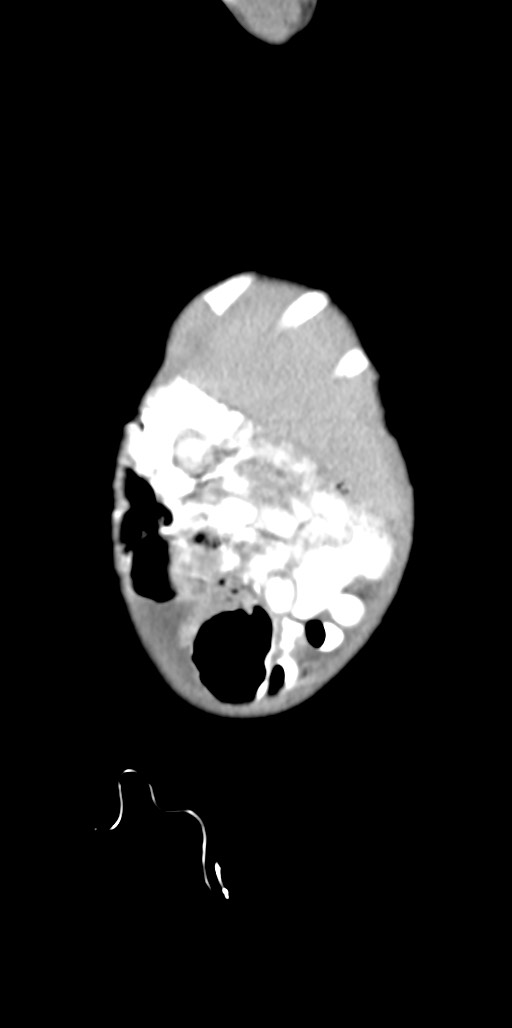 Abdominopelvic rhabdomyosarcoma (Radiopaedia 78356-90984 Sagittal C+ portal venous phase 93).jpg