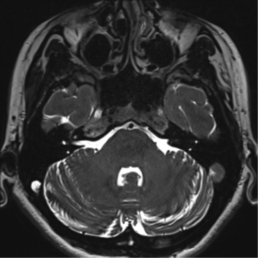 Abducens nerve palsy (Radiopaedia 51069-56648 Axial T2 fat sat 26).png