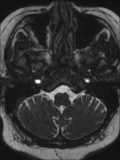 Abducens nerve palsy (Radiopaedia 57084-63976 Axial T2 ciss 3d 10).jpg