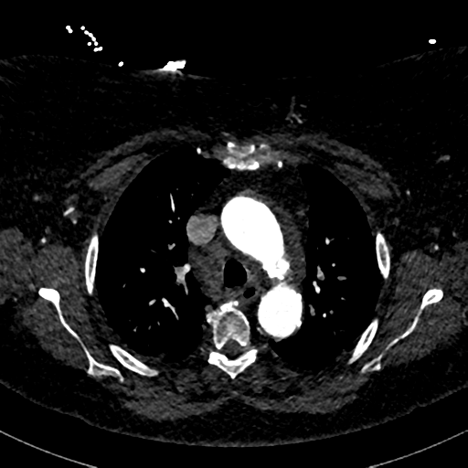 Aberrant right subclavian artery with Kommerell diverticulum (Radiopaedia 47982-52769 Axial C+ arterial phase 30).png