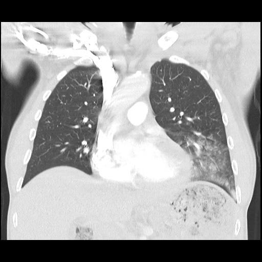 Accessory left horizontal fissure with lingular pneumonia (Radiopaedia 53763-59843 Coronal lung window 20).jpg