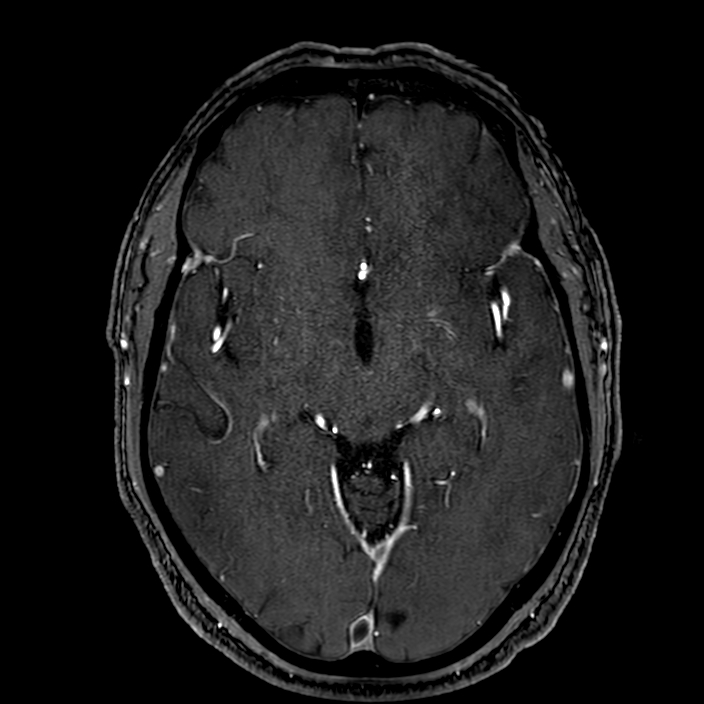 Accessory middle cerebral artery (Radiopaedia 73114-83828 Axial MRA 87).jpg