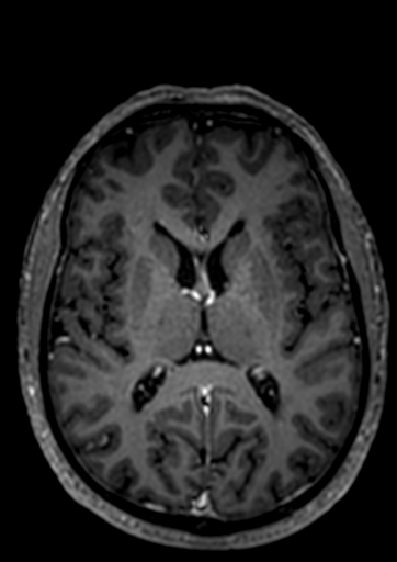 Accessory middle cerebral artery (Radiopaedia 73114-83828 Axial T1 C+ 18).jpg