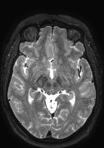 Accessory middle cerebral artery (Radiopaedia 73114-83828 Axial T2 95).jpg