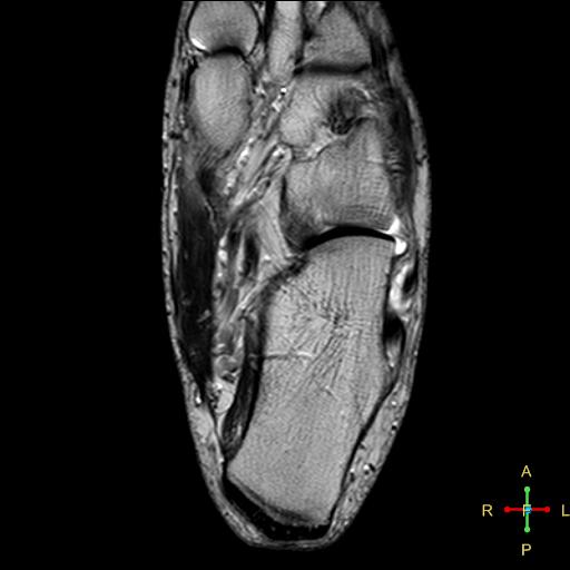 File:Achilles tendon complete tear (Radiopaedia 22834-22854 Axial T2 1).jpg