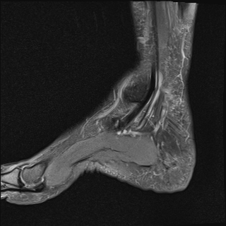 File:Achilles tendon tear (Radiopaedia 77615-89819 Sagittal PD fat sat 4).jpg