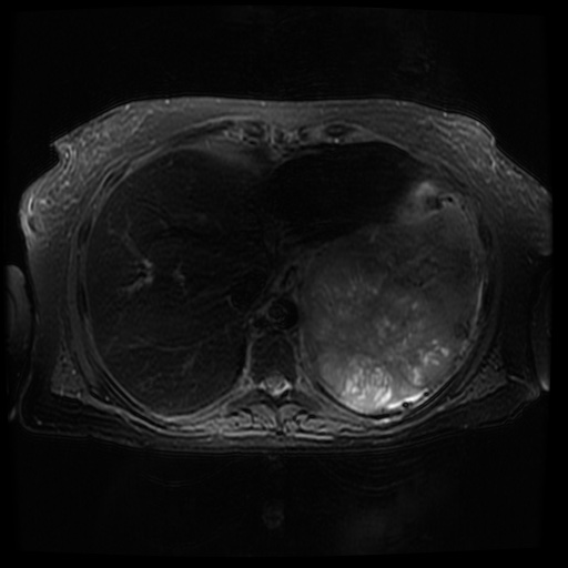 Acinar cell carcinoma of the pancreas (Radiopaedia 75442-86668 Axial T2 fat sat 15).jpg