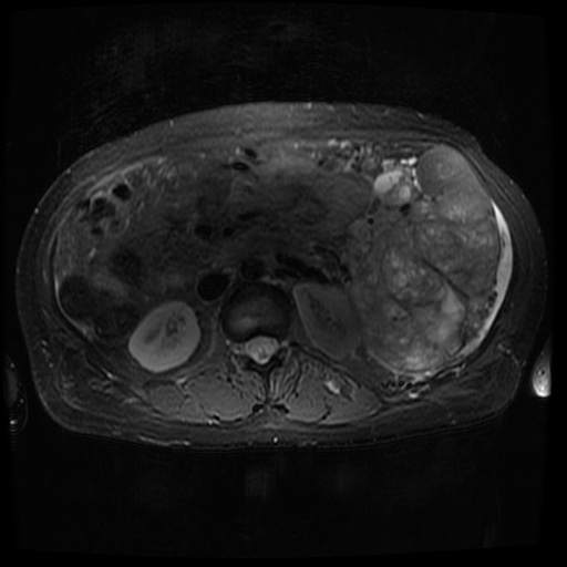 File:Acinar cell carcinoma of the pancreas (Radiopaedia 75442-86668 Axial T2 fat sat 41).jpg