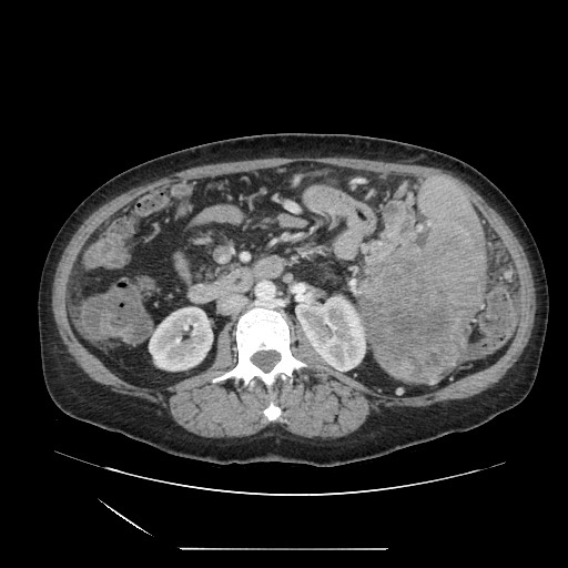 Acinar cell carcinoma of the pancreas (Radiopaedia 75442-86669 Axial C+ portal venous phase 66).jpg