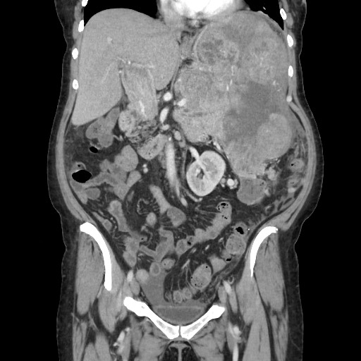 Acinar cell carcinoma of the pancreas (Radiopaedia 75442-86669 Coronal C+ portal venous phase 57).jpg