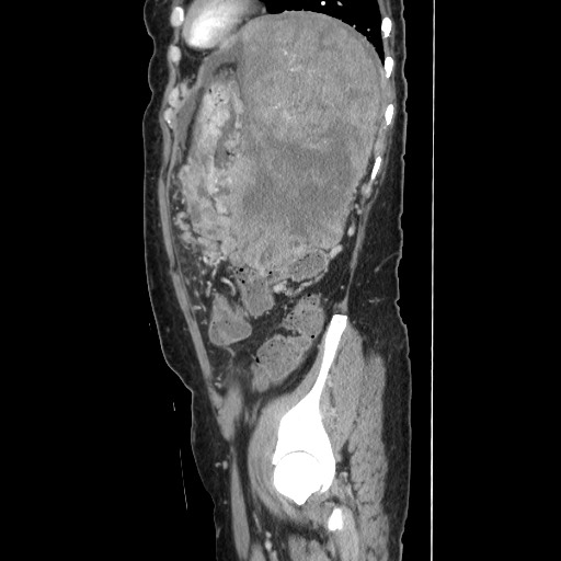 Acinar cell carcinoma of the pancreas (Radiopaedia 75442-86669 Sagittal C+ portal venous phase 146).jpg