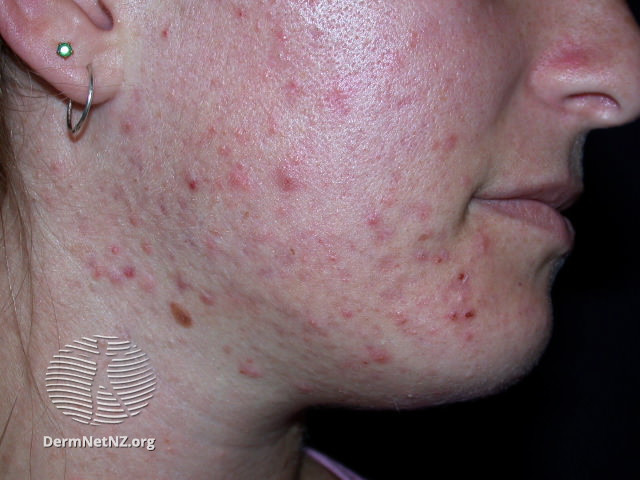 File:Acne-face 1 27 (DermNet NZ acne-acne-face-acne-face-1-27).jpg