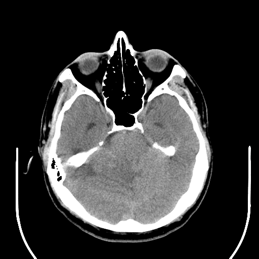 File:Acoustic schwannoma (Radiopaedia 39170-41388 Axial non-contrast 16).png