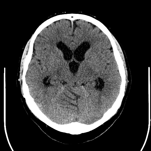 File:Acoustic schwannoma (Radiopaedia 39170-41389 Axial non-contrast 12).png