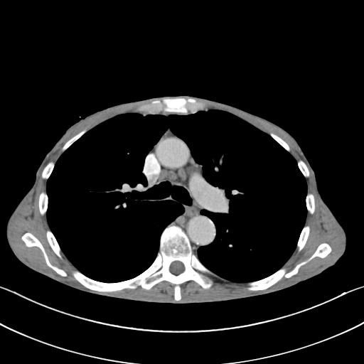 File:Acquired tracheoesophageal fistula (Radiopaedia 57747-65042 Axial C+ portal venous phase 38).jpg
