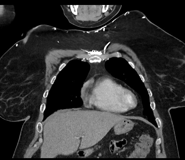 Acromioclavicular joint cyst (Radiopaedia 58455-65610 Coronal C+ arterial phase 45).jpg