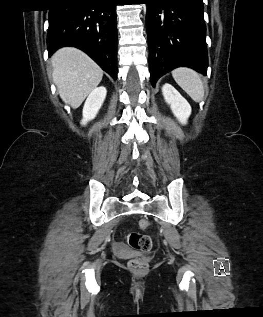 Active Crohn disease (Radiopaedia 59394-66750 Coronal C+ portal venous phase 54).jpg