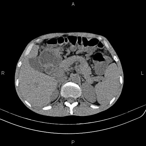 Active crohn disease (Radiopaedia 87133-103397 Axial non-contrast 28).jpg