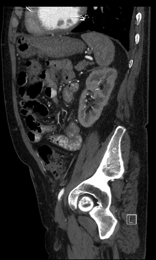 Active lower gastrointestinal bleeding - diverticular (Radiopaedia 61203-69106 Sagittal C+ arterial phase 48).jpg
