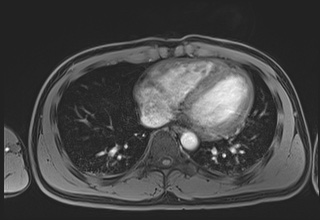 Active right ventricular cardiac sarcoidosis (Radiopaedia 55596-62100 Axial Post contrast Dixon 53).jpg