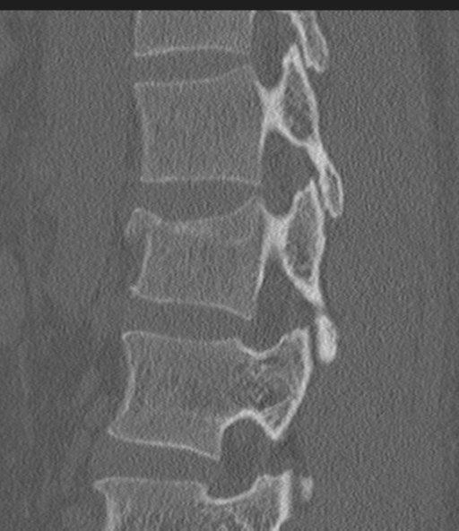 Acute L1 burst compression fracture (Radiopaedia 34430-35755 Sagittal bone window 25).png