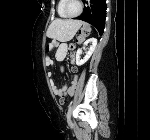 Acute appendicitis, heterotaxy syndrome (Radiopaedia 66884-76202 Sagittal C+ portal venous phase 91).jpg