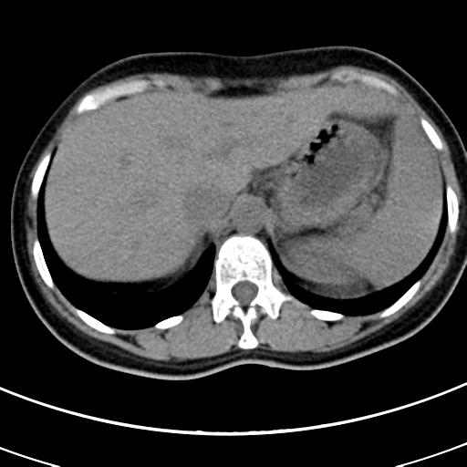 Acute appendicitis (Radiopaedia 30261-30888 Axial non-contrast 5).jpg