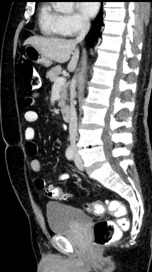 Acute appendicitis (Radiopaedia 77016-88960 Sagittal C+ portal venous phase 59).jpg