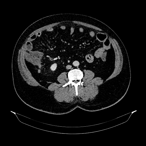 File:Acute appendicitis (Radiopaedia 79950-93224 Axial C+ portal venous phase 59).jpg