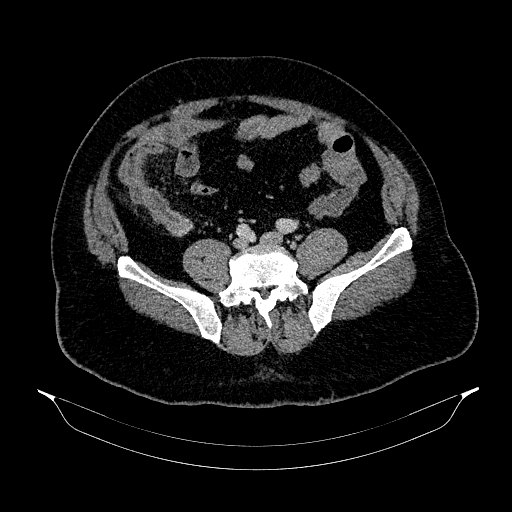 Acute appendicitis (Radiopaedia 79950-93224 Axial C+ portal venous phase 72).jpg