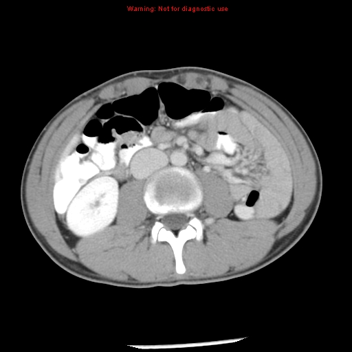 Acute appendicitis (Radiopaedia 8195-9045 Axial C+ portal venous phase 36).jpg