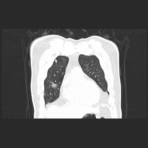 Acute appendicitis and COVID 19 pneumonia (Radiopaedia 76604-88380 G 15).jpg