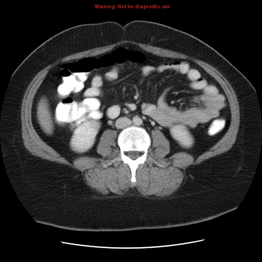 File:Acute appendicitis complicated by ovarian vein thrombophlebitis (Radiopaedia 16172-15851 Axial C+ portal venous phase 52).jpg