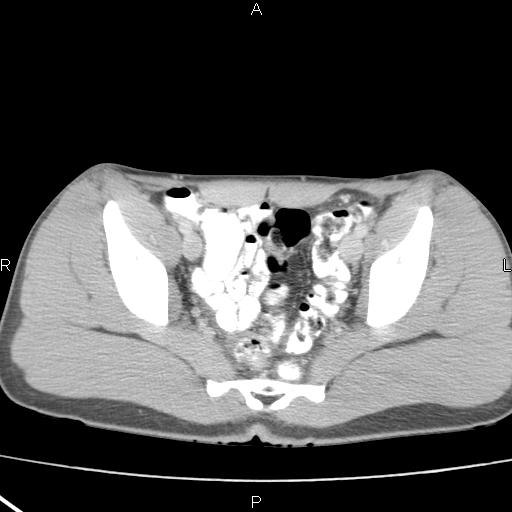 File:Acute appendicitis with CT arrowhead sign (Radiopaedia 21474-21411 Axial C+ portal venous phase 35).jpg